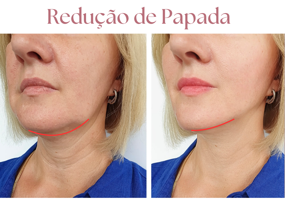 V-DermaLift – Máscara de Contorno Facial que Reduz Papada, Suaviza Rugas e Define o Rosto