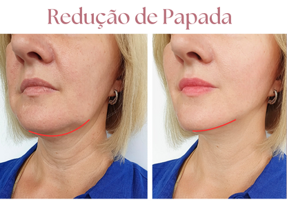V-DermaLift – Máscara de Contorno Facial que Reduz Papada, Suaviza Rugas e Define o Rosto