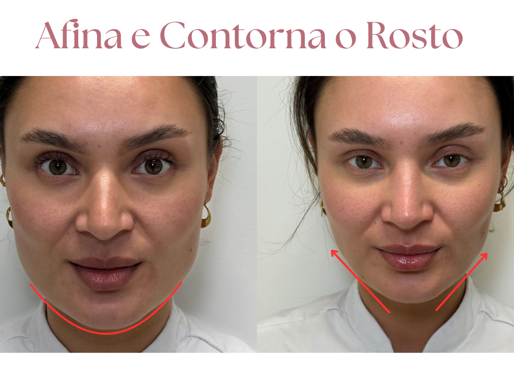 V-DermaLift – Máscara de Contorno Facial que Reduz Papada, Suaviza Rugas e Define o Rosto